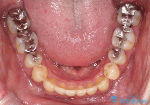 再矯正症例　前歯のガタガタと噛み合わせのズレをマウスピースで治した症例の治療後