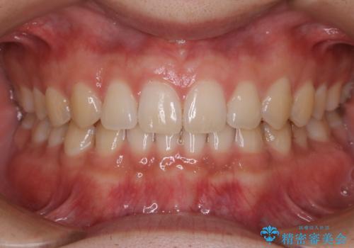 すきっ歯が気になる:見た目も噛み合わせもインビザラインでまとめて治すの治療後