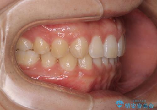 すきっ歯が気になる:見た目も噛み合わせもインビザラインでまとめて治すの治療後