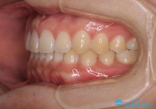 すきっ歯が気になる:見た目も噛み合わせもインビザラインでまとめて治すの治療後