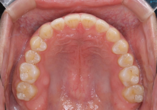 すきっ歯が気になる:見た目も噛み合わせもインビザラインでまとめて治すの治療後