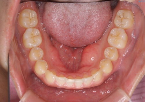 すきっ歯が気になる:見た目も噛み合わせもインビザラインでまとめて治すの治療後