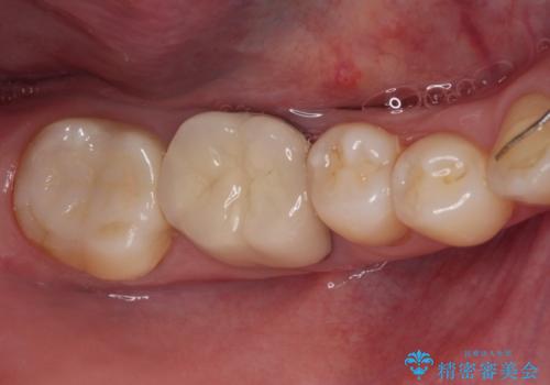 奥歯に物が挟まる　セラミックインレーによる虫歯治療の症例 治療後