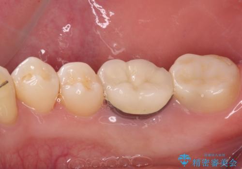 奥歯に物が挟まる セラミックインレーによる虫歯治療の治療後
