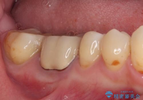 奥歯に物が挟まる セラミックインレーによる虫歯治療の治療後