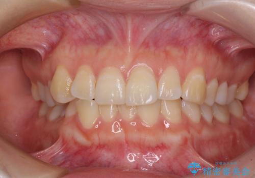 【モニター】前歯のデコボコを目立たないワイヤー装置で短期間矯正治療の症例 治療前
