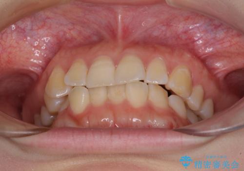 【モニター】前歯のデコボコを目立たないワイヤー装置で短期間矯正治療の治療前