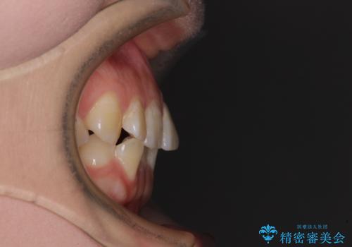 【モニター】前歯のデコボコを目立たないワイヤー装置で短期間矯正治療の治療前