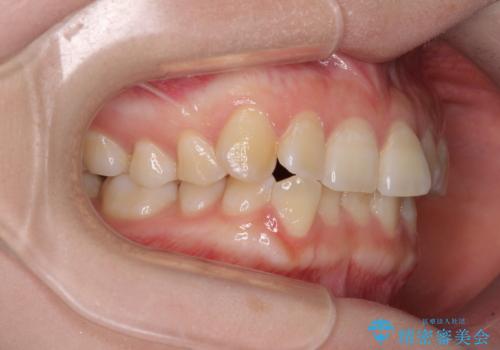 【モニター】前歯のデコボコを目立たないワイヤー装置で短期間矯正治療の治療前