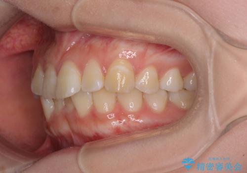 【モニター】前歯のデコボコを目立たないワイヤー装置で短期間矯正治療の治療前