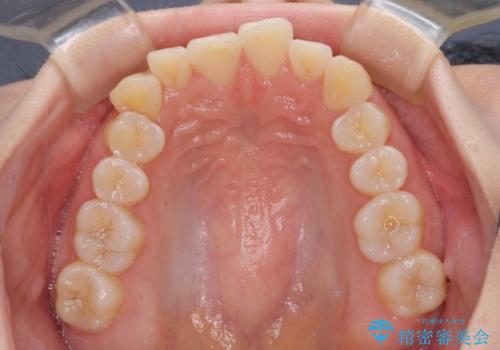 【モニター】前歯のデコボコを目立たないワイヤー装置で短期間矯正治療の治療前