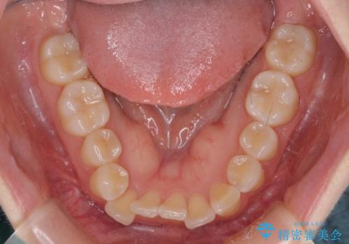 【モニター】前歯のデコボコを目立たないワイヤー装置で短期間矯正治療の治療前