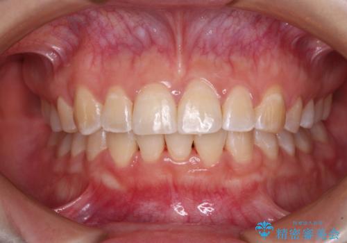 【モニター】前歯のデコボコを目立たないワイヤー装置で短期間矯正治療
