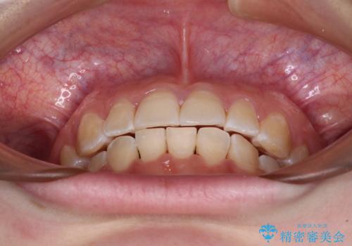 【モニター】前歯のデコボコを目立たないワイヤー装置で短期間矯正治療の治療後