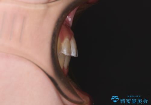 【モニター】前歯のデコボコを目立たないワイヤー装置で短期間矯正治療の治療後