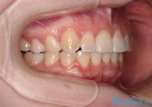 【モニター】前歯のデコボコを目立たないワイヤー装置で短期間矯正治療の治療後