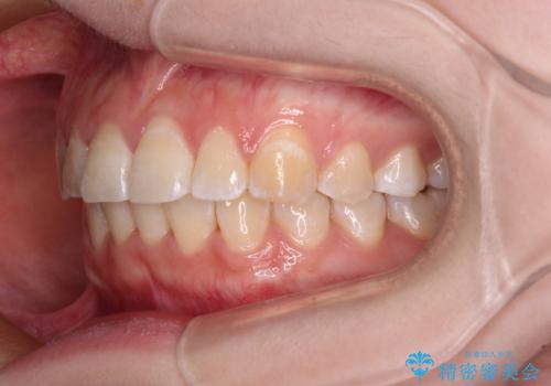 【モニター】前歯のデコボコを目立たないワイヤー装置で短期間矯正治療の治療後