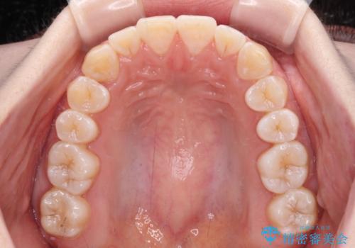 【モニター】前歯のデコボコを目立たないワイヤー装置で短期間矯正治療の治療後