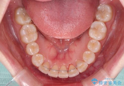 【モニター】前歯のデコボコを目立たないワイヤー装置で短期間矯正治療の治療後
