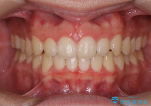 前歯が見えすぎる:インビザラインFULLで奥歯の噛み合わせも改善の症例 治療後