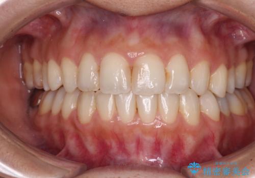 オープンバイトによる見た目を治したい インビザラインでの矯正治療の症例 治療後