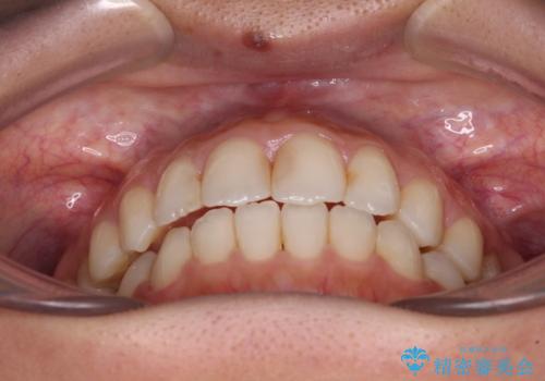 オープンバイトによる見た目を治したい インビザラインでの矯正治療の治療後