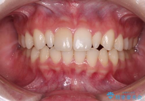 【モニター】ワイヤー矯正で手っ取り早く治療の症例 治療後