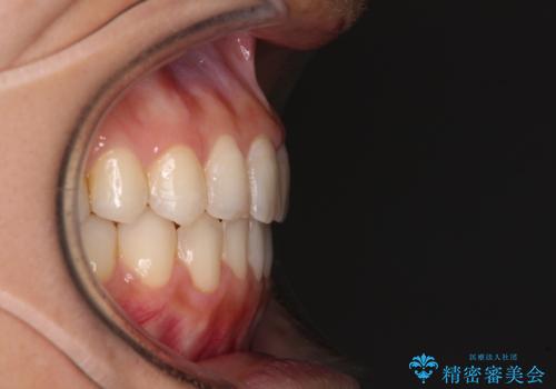 オープンバイトによる見た目を治したい インビザラインでの矯正治療の治療後