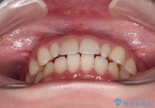 【モニター】ワイヤー矯正で手っ取り早く治療の治療後