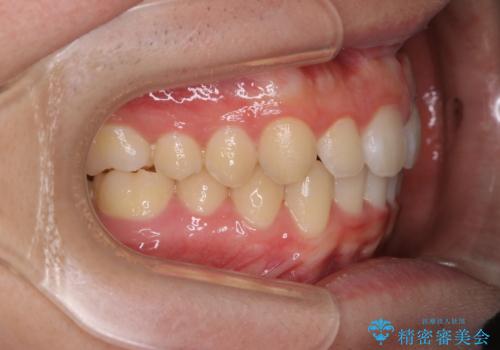 前歯が見えすぎる:インビザラインFULLで奥歯の噛み合わせも改善の治療後