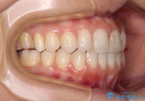 オープンバイトによる見た目を治したい インビザラインでの矯正治療の治療後