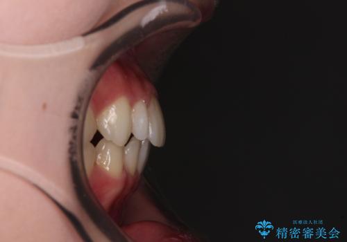 【モニター】ワイヤー矯正で手っ取り早く治療の治療後