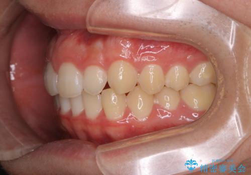 前歯が見えすぎる:インビザラインFULLで奥歯の噛み合わせも改善の治療後