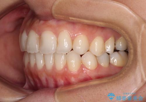 オープンバイトによる見た目を治したい インビザラインでの矯正治療の治療後