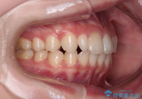 【モニター】ワイヤー矯正で手っ取り早く治療の治療後