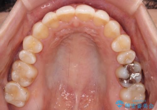 オープンバイトによる見た目を治したい インビザラインでの矯正治療の治療後