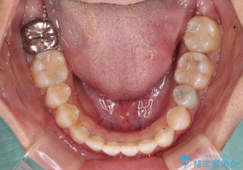 オープンバイトによる見た目を治したい インビザラインでの矯正治療の治療後