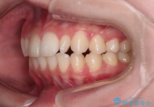 【モニター】ワイヤー矯正で手っ取り早く治療の治療後