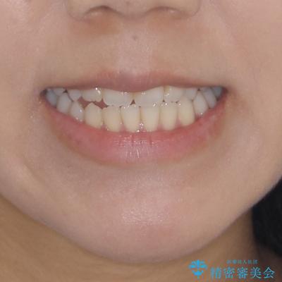 オープンバイトによる見た目を治したい インビザラインでの矯正治療の治療前(顔貌)