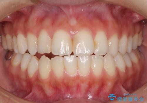 オープンバイトによる見た目を治したい インビザラインでの矯正治療の症例 治療前