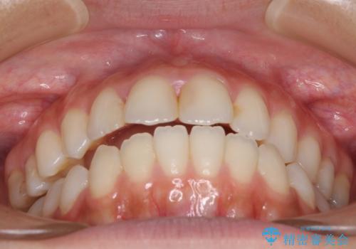 オープンバイトによる見た目を治したい インビザラインでの矯正治療の治療前