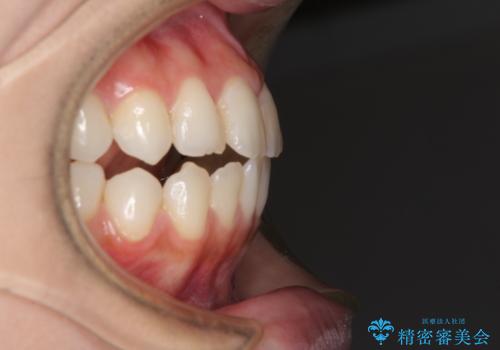 オープンバイトによる見た目を治したい インビザラインでの矯正治療の治療前