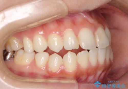 オープンバイトによる見た目を治したい インビザラインでの矯正治療の治療前