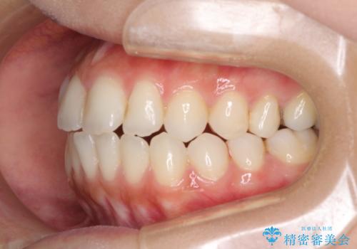 オープンバイトによる見た目を治したい インビザラインでの矯正治療の治療前