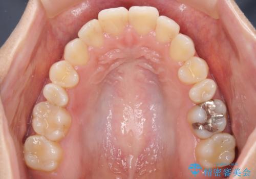 オープンバイトによる見た目を治したい インビザラインでの矯正治療の治療前