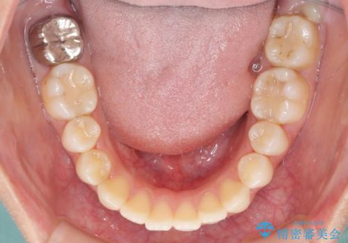 オープンバイトによる見た目を治したい インビザラインでの矯正治療の治療前