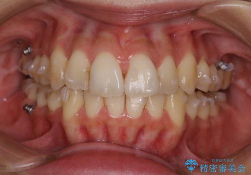 インビザラインの矯正チェック時にクリーニングも