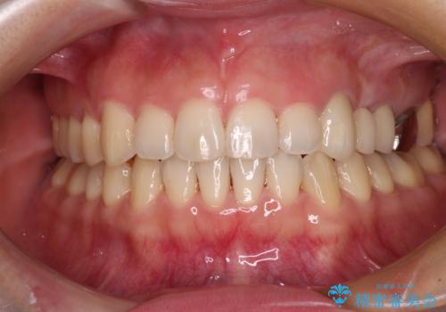 捻れた前歯と銀歯のブリッジを治したい ワイヤー矯正とオールセラミックブリッジの治療後