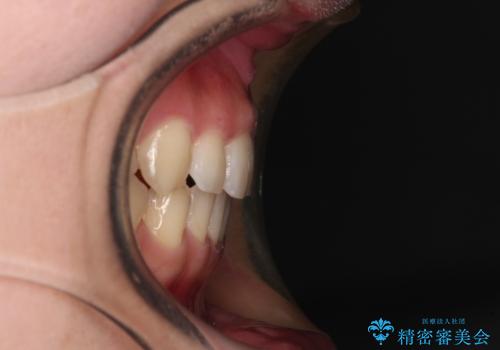 捻れた前歯と銀歯のブリッジを治したい ワイヤー矯正とオールセラミックブリッジの治療後