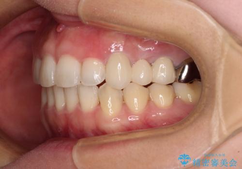 捻れた前歯と銀歯のブリッジを治したい ワイヤー矯正とオールセラミックブリッジの治療後